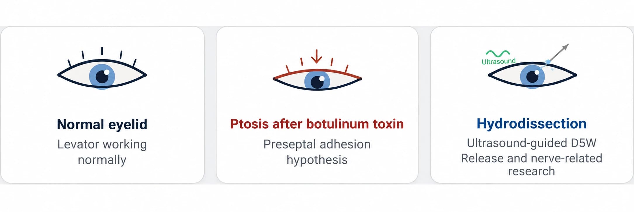 Hydrodissection research for botulinum-toxin-related ptosis — source material 2 — AI-assisted English adaptation; not an unedited medical original