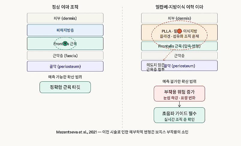 시술 이력에 따른 이마 조직 변화를 비교한 원문 도해 — 재료 분류·해부학 검수 대기