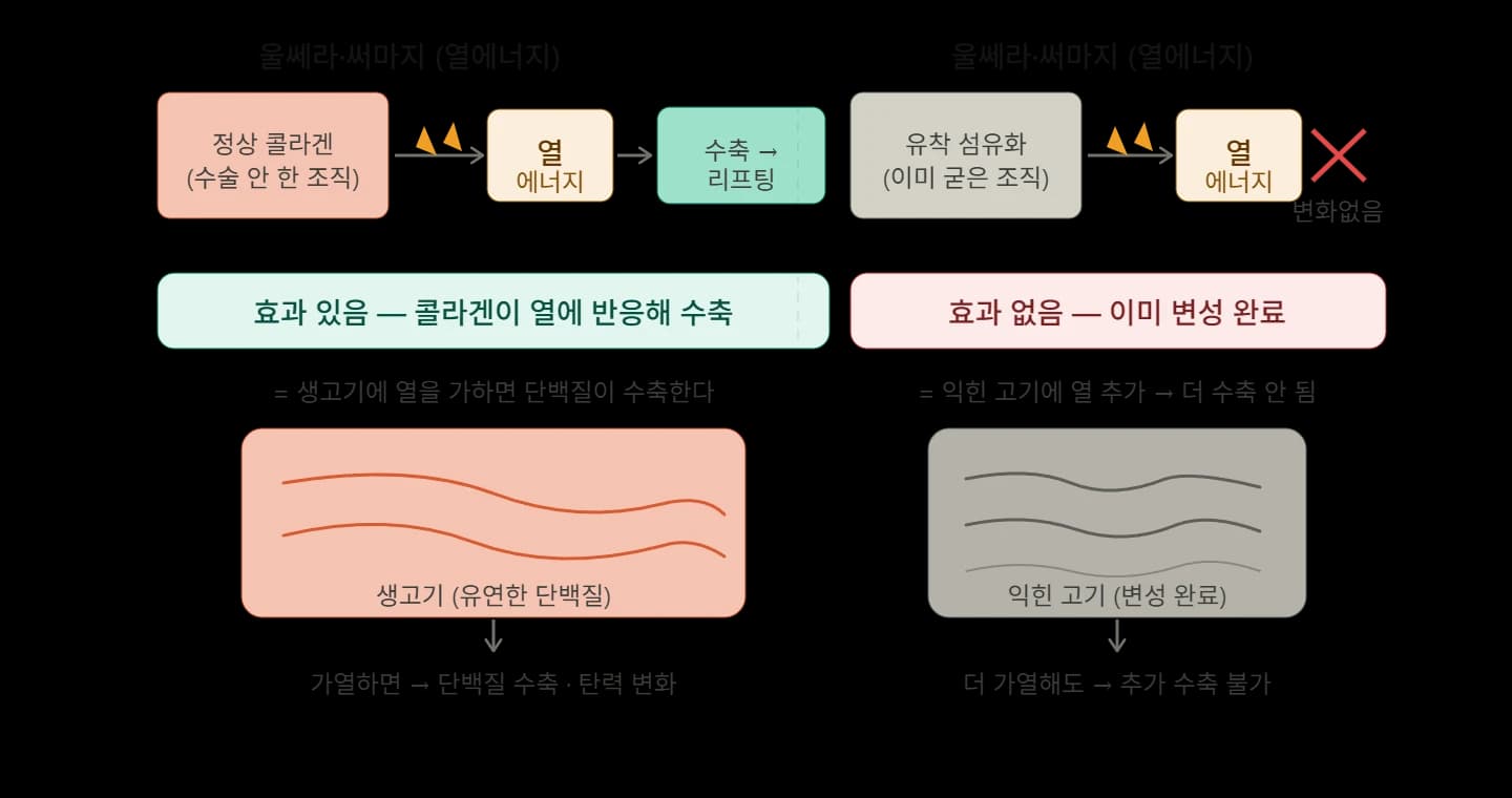 에너지 시술 후 조직 변화와 비유의 한계 — 원문 자료 5