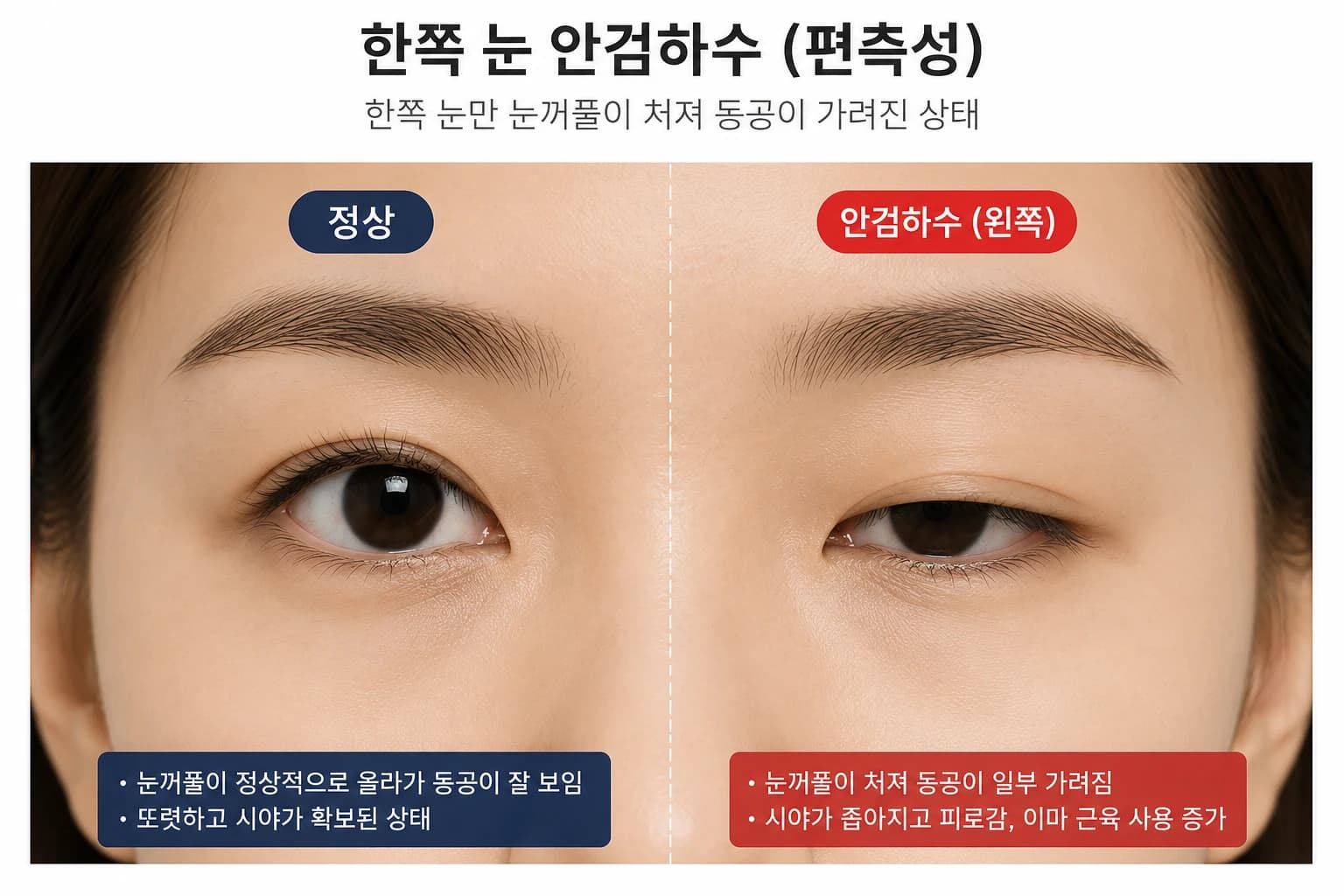 한쪽 눈꺼풀 처짐을 표현한 원문 개념 이미지