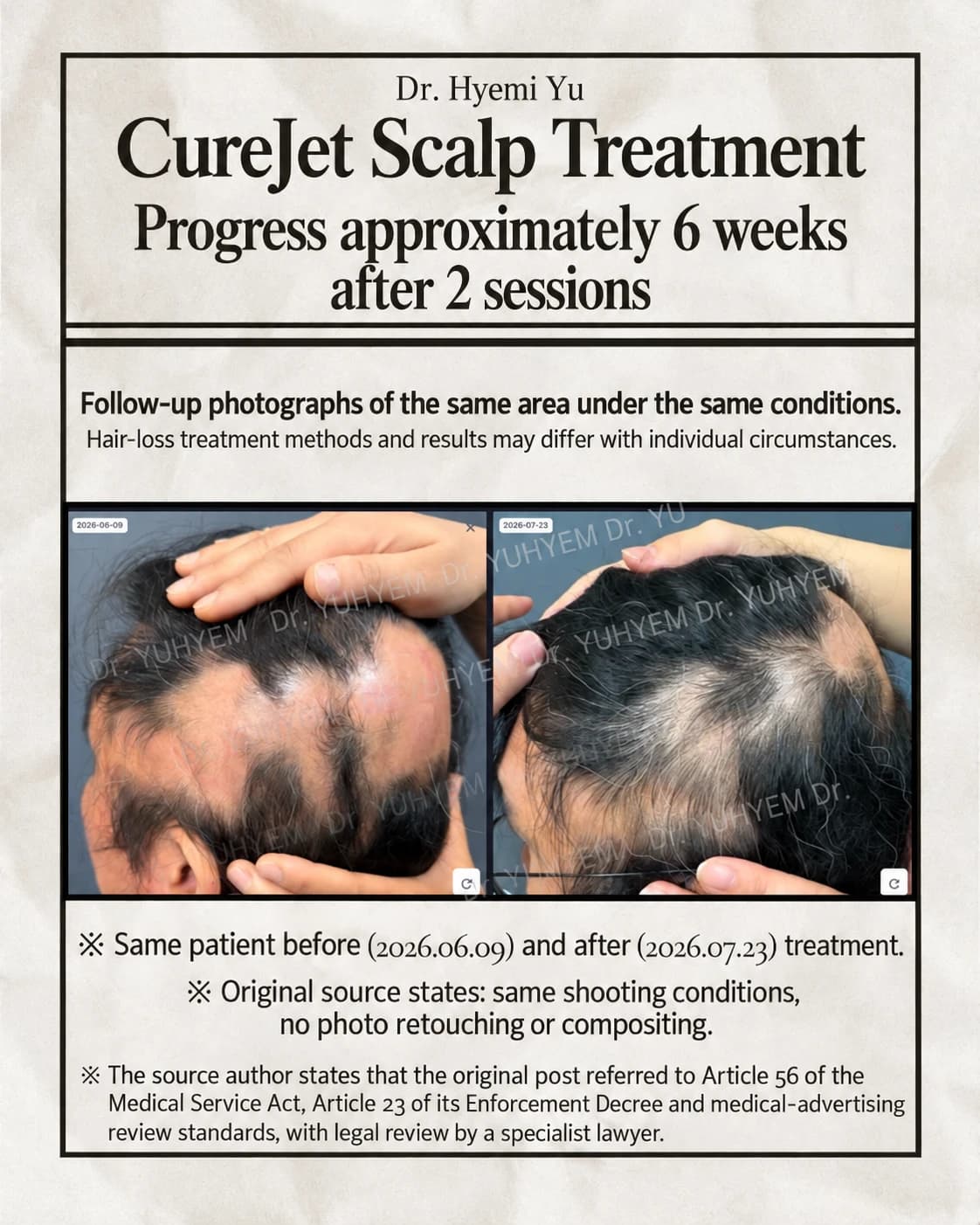 Source hair-loss case comparison graphic — individual course and consent require review — English text-localized rendition, not the unedited clinical original