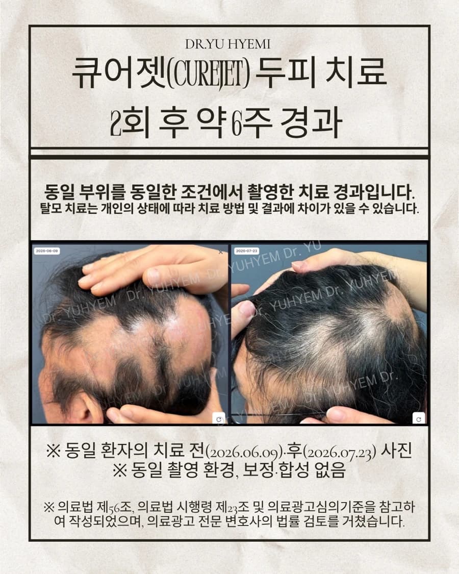 원문 탈모 사례의 전후 사진 안내문 — 개인 경과·게시 동의 검수 대상