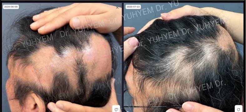 Original follow-up comparison photographs in an individual hair-loss case