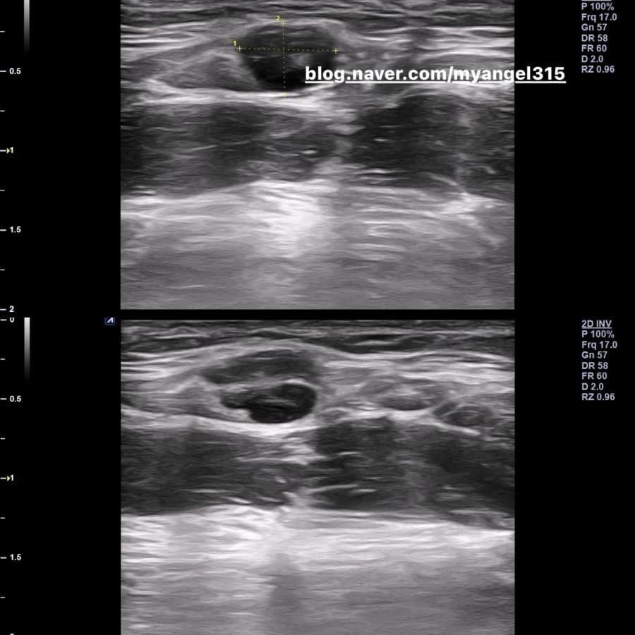 Ultrasound from a source case — imaging alone does not establish composition or efficacy