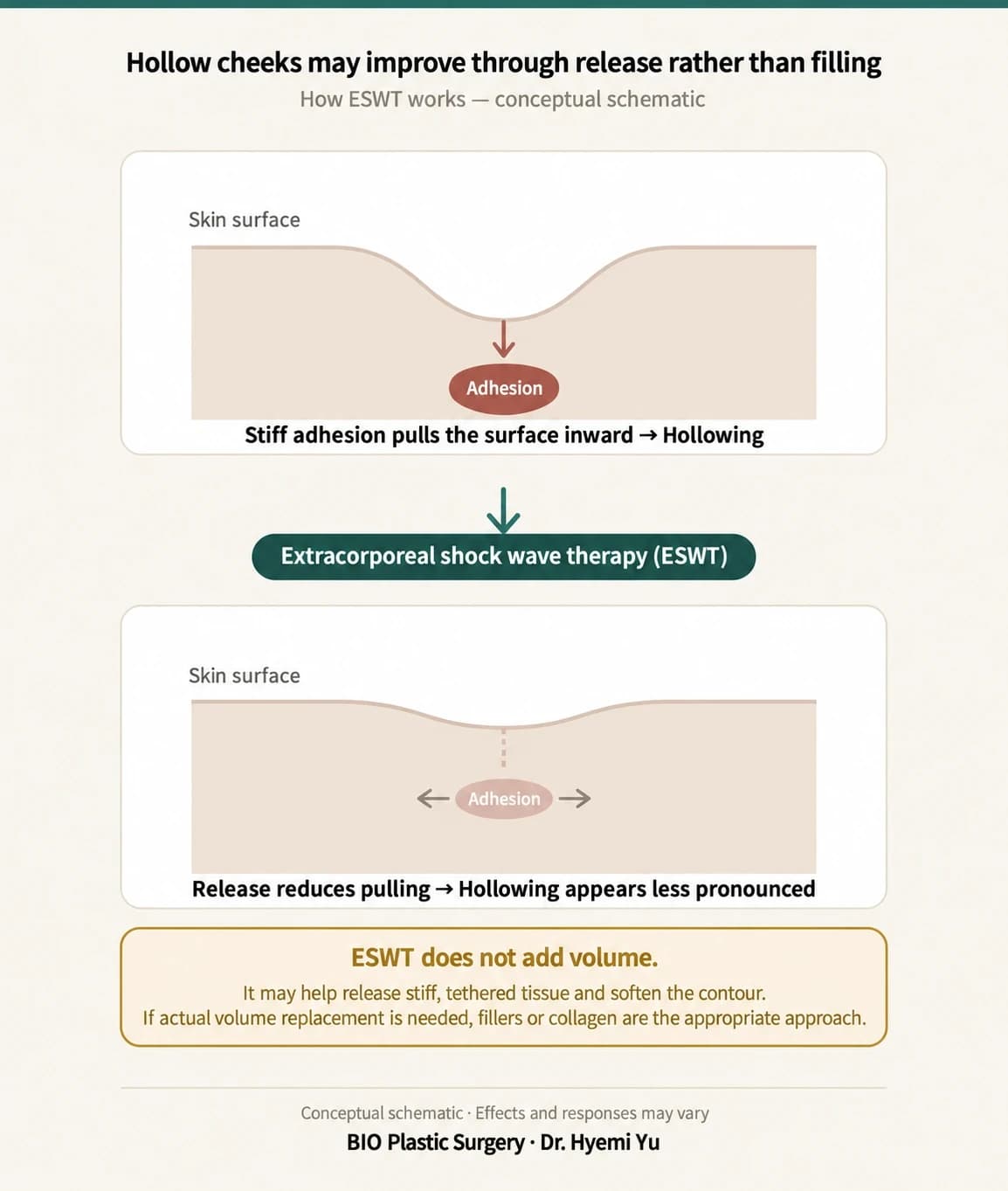 A conceptual diagram of adhesion-related pulling and the possible role of ESWT
