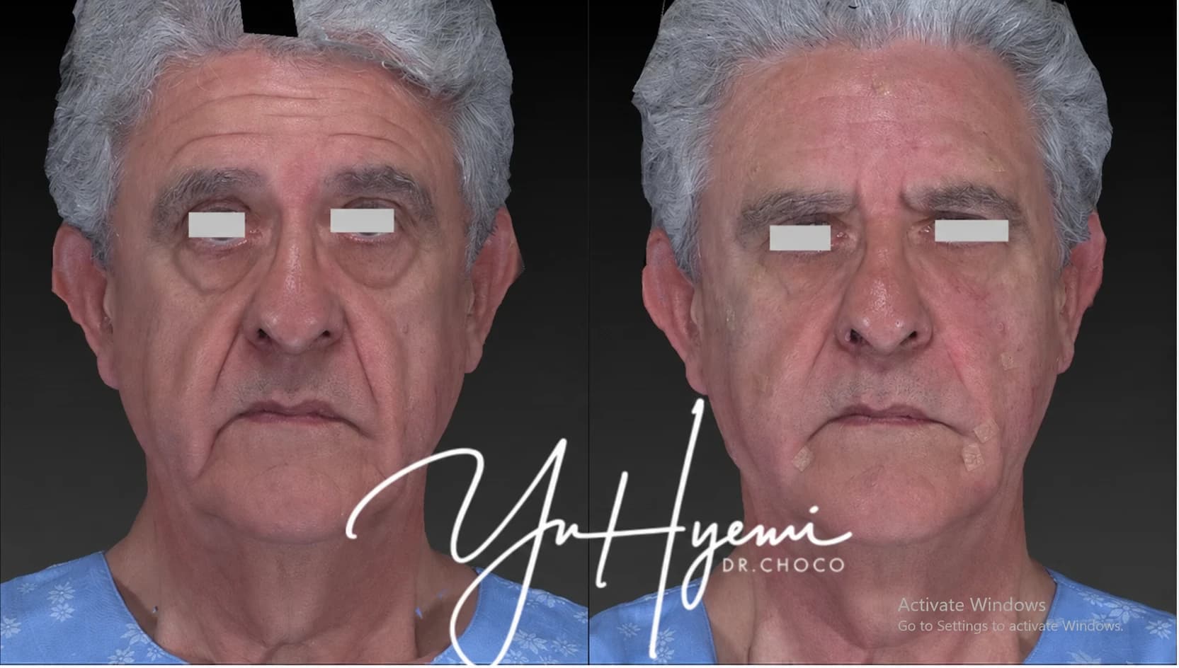 Individual frontal comparison photographs — AI-assisted English text adaptation; not an unedited medical original