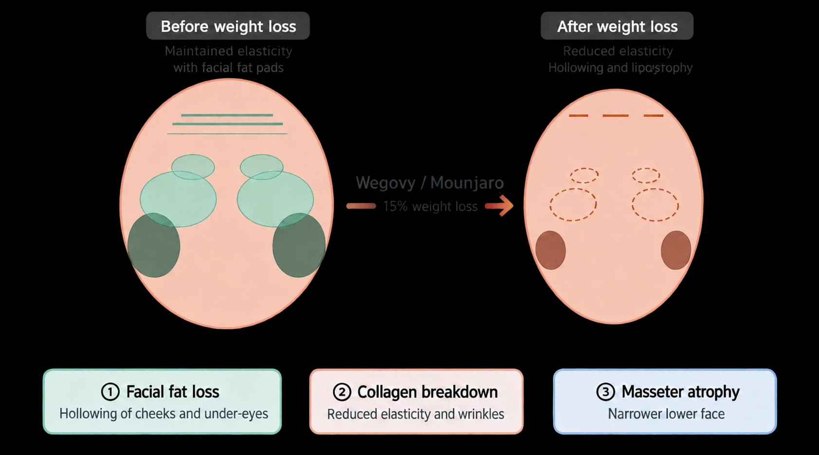 Considering muscle preservation during GLP-1 treatment — source material 1 — AI-assisted English adaptation; not an unedited medical original