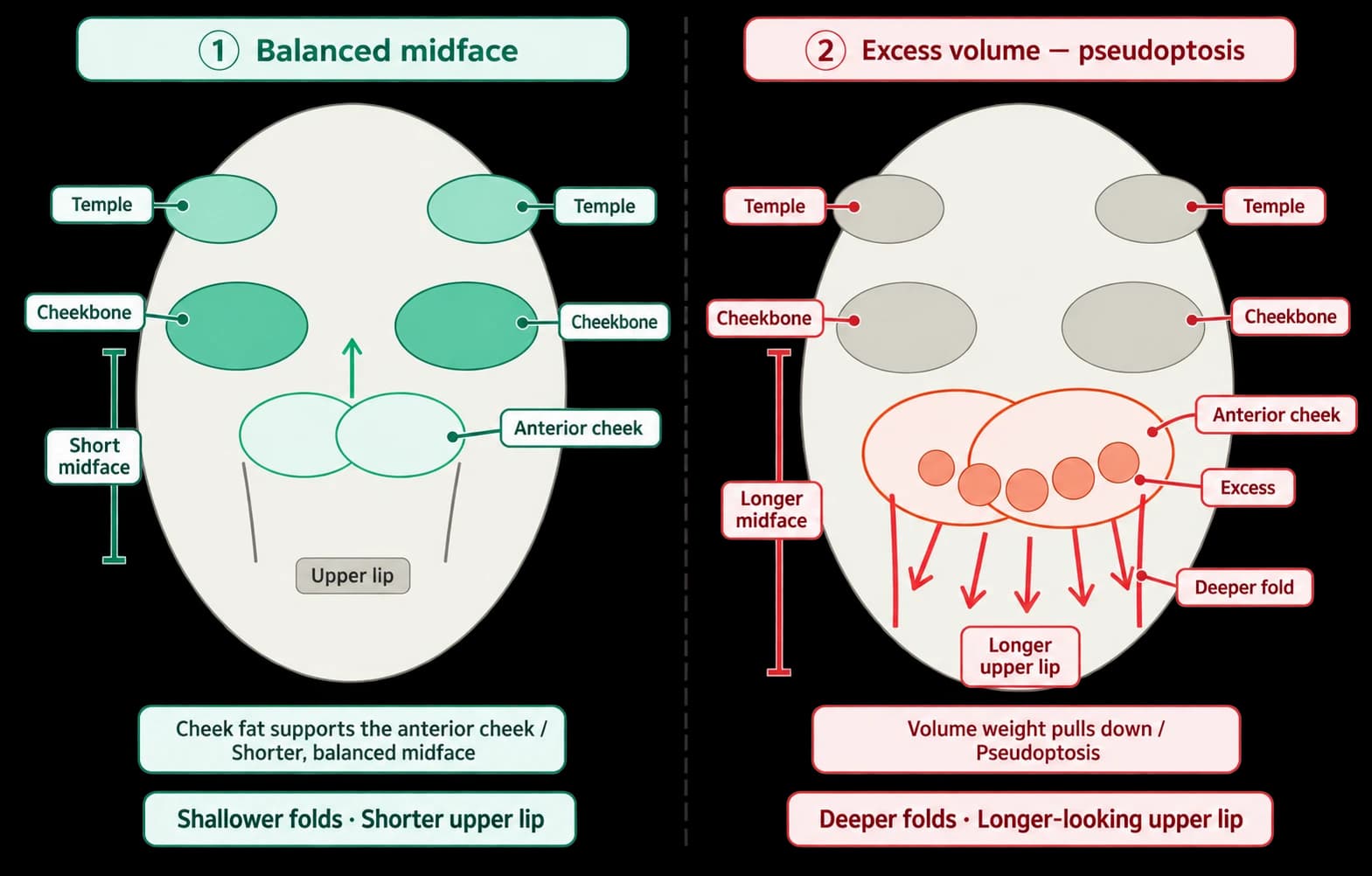 Nasolabial fillers and upper-lip proportions — source material 2 — AI-assisted English adaptation; not an unedited medical original