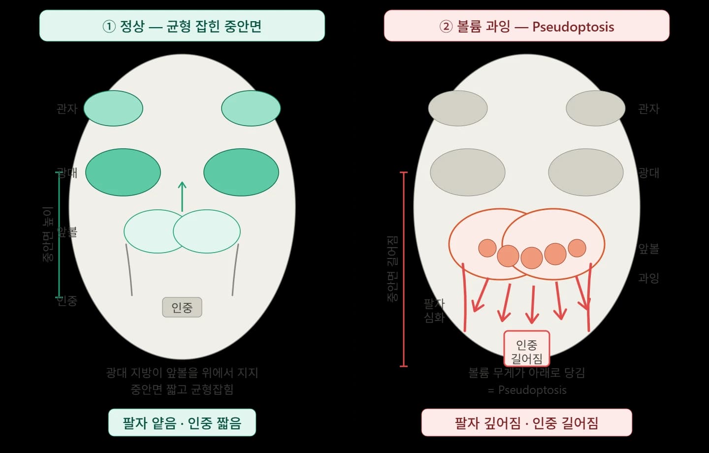 팔자주름 필러와 인중 비율에 관한 연구 — 원문 자료 2