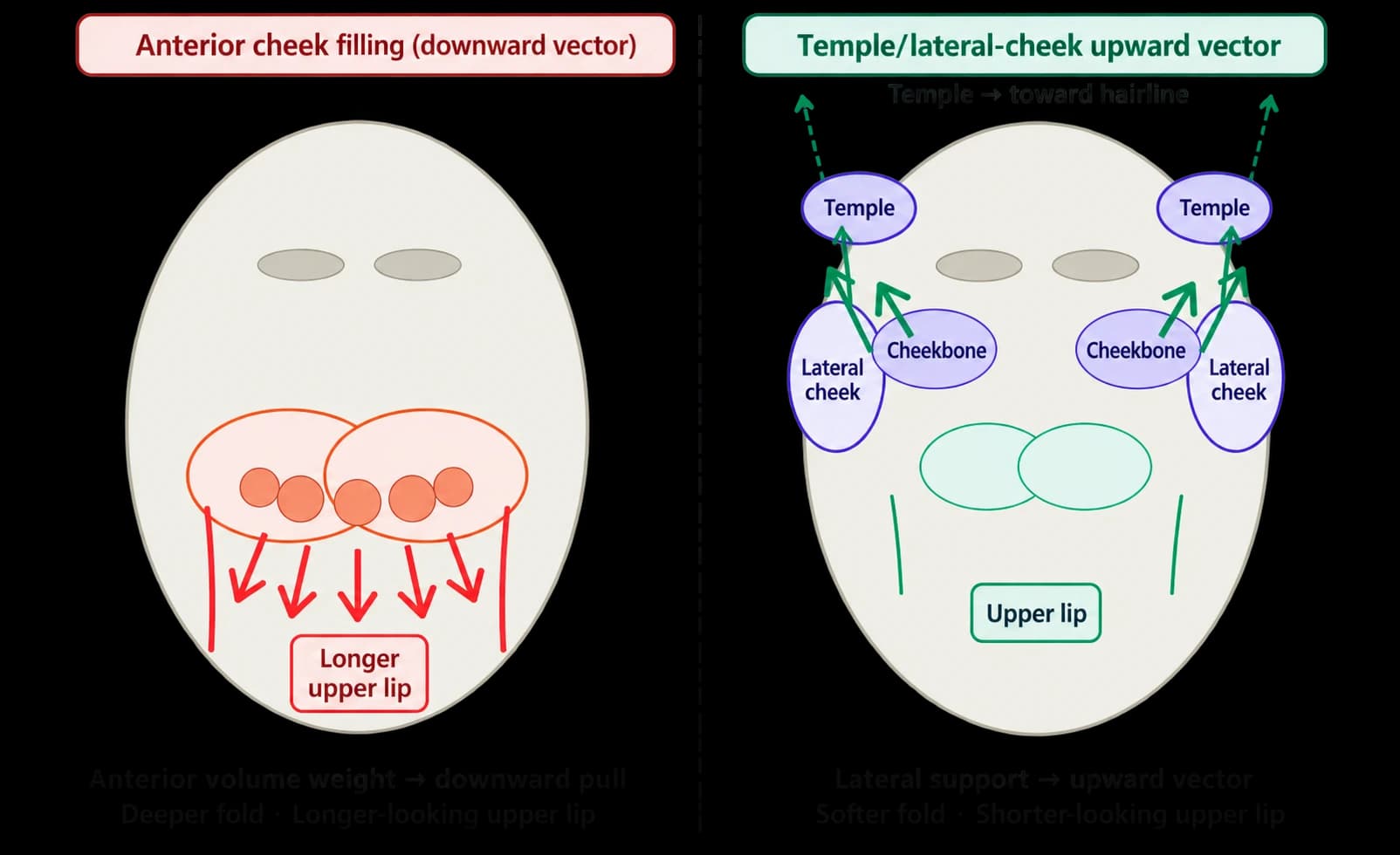 Nasolabial fillers and upper-lip proportions — source material 5 — AI-assisted English adaptation; not an unedited medical original