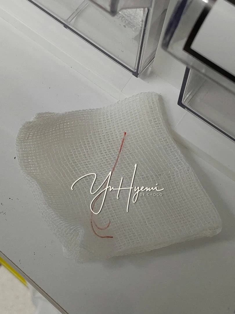 원문 코리프팅 사례에서 제거한 실 사진