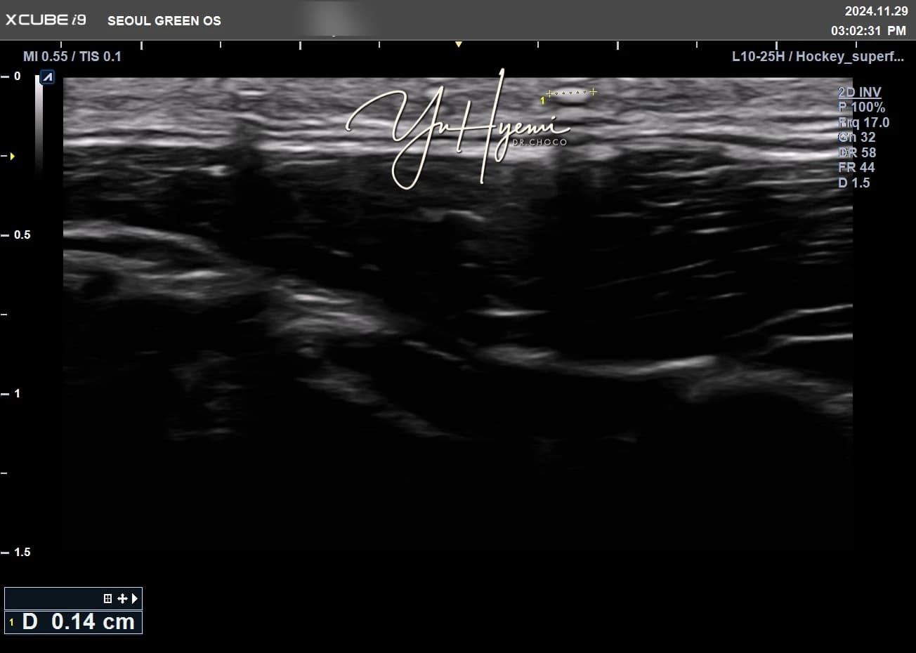 Ultrasound from a source case — imaging alone does not establish composition or efficacy