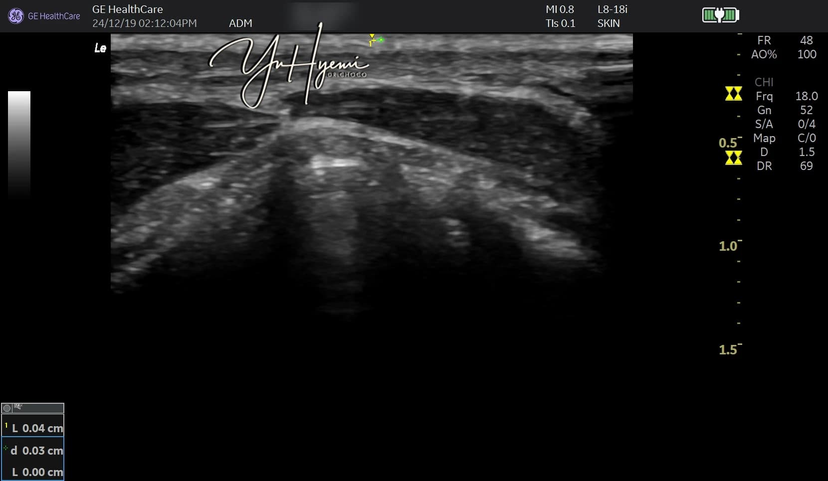 Ultrasound from a source case — imaging alone does not establish composition or efficacy