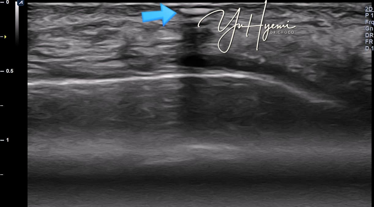 Marked individual ultrasound image