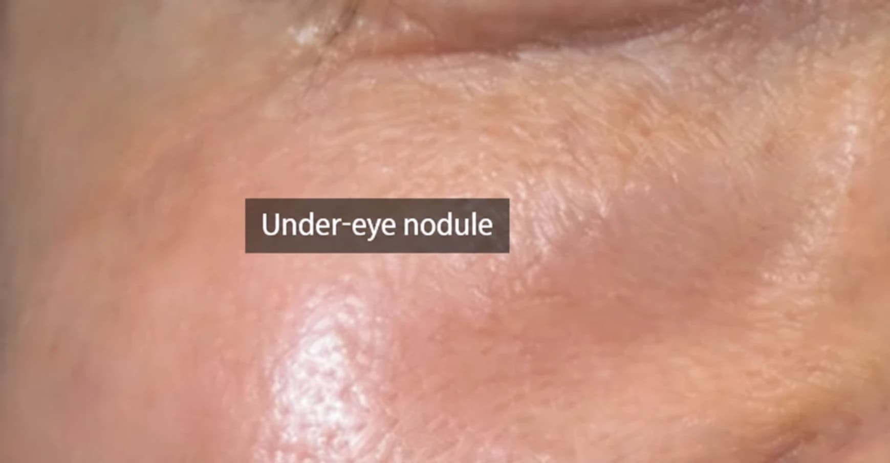 Source case photograph labeled under-eye nodule, image 1 — English text-localized rendition; consult the original for clinical interpretation