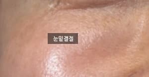 원문 사례의 눈밑 결절 표기 사진 1