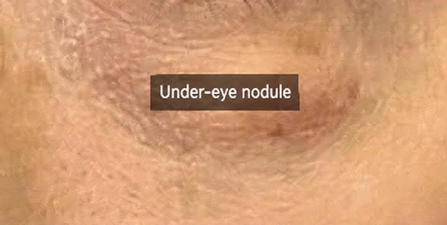Source case photograph labeled under-eye nodule, image 2 — English text-localized rendition; consult the original for clinical interpretation