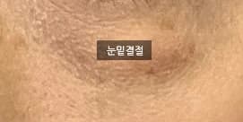 원문 사례의 눈밑 결절 표기 사진 2