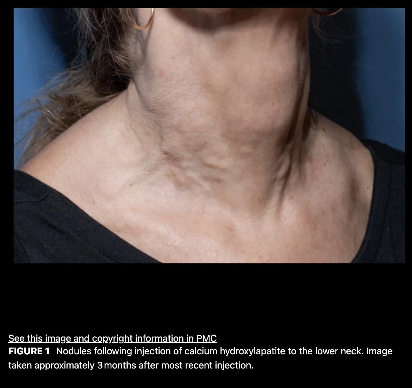 Source paper photograph of CaHA neck nodules