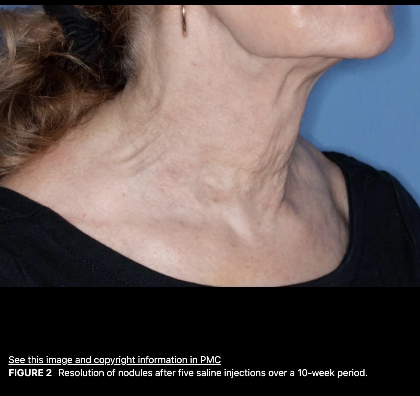Source paper follow-up photograph — individual case