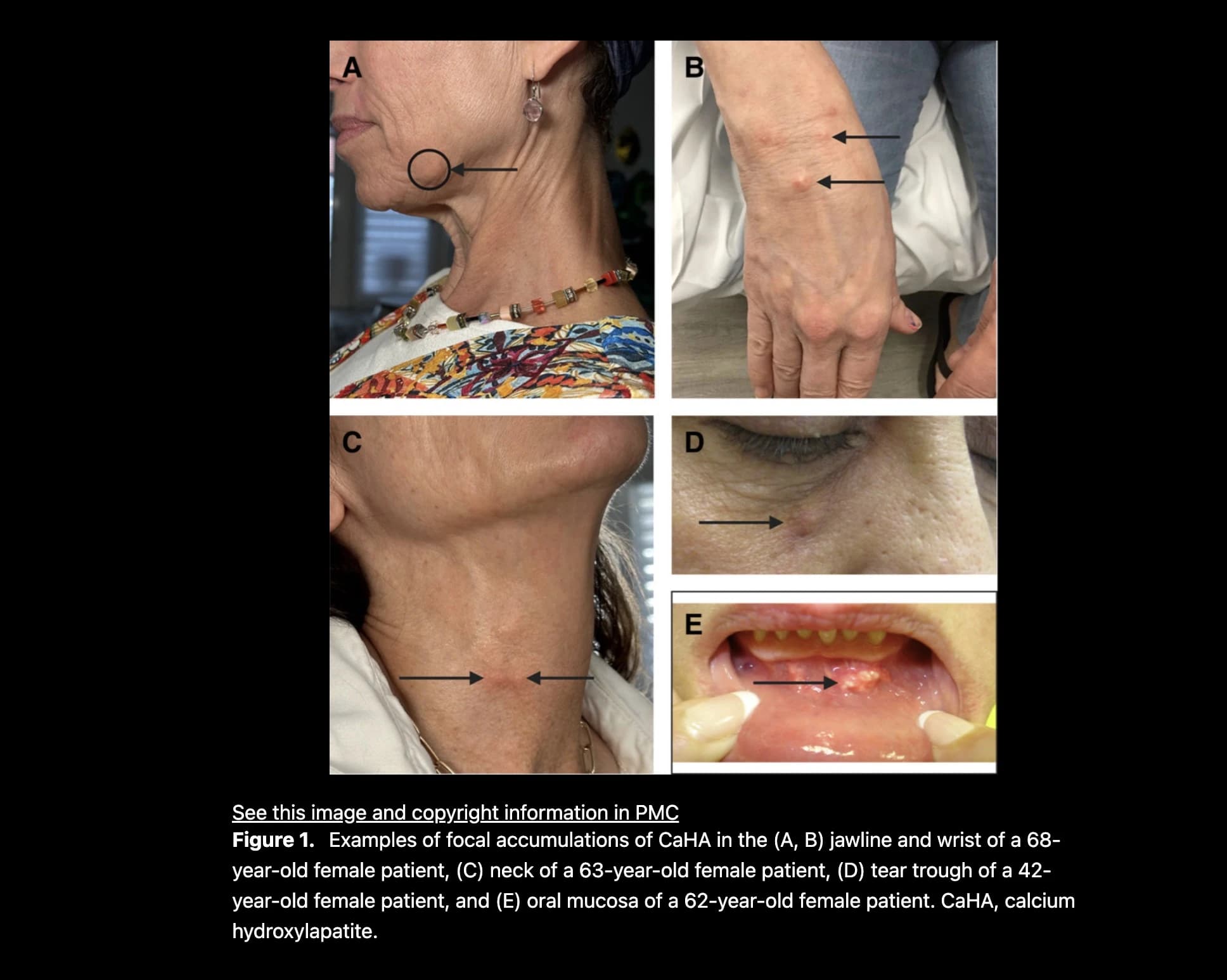 Source paper examples of focal CaHA accumulation at different sites