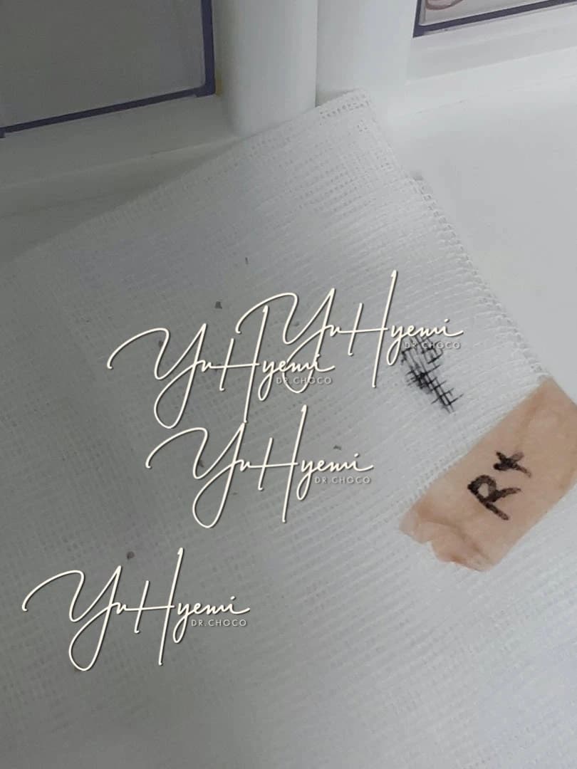 원문 결절 제거 사례에서 촬영한 조직 사진