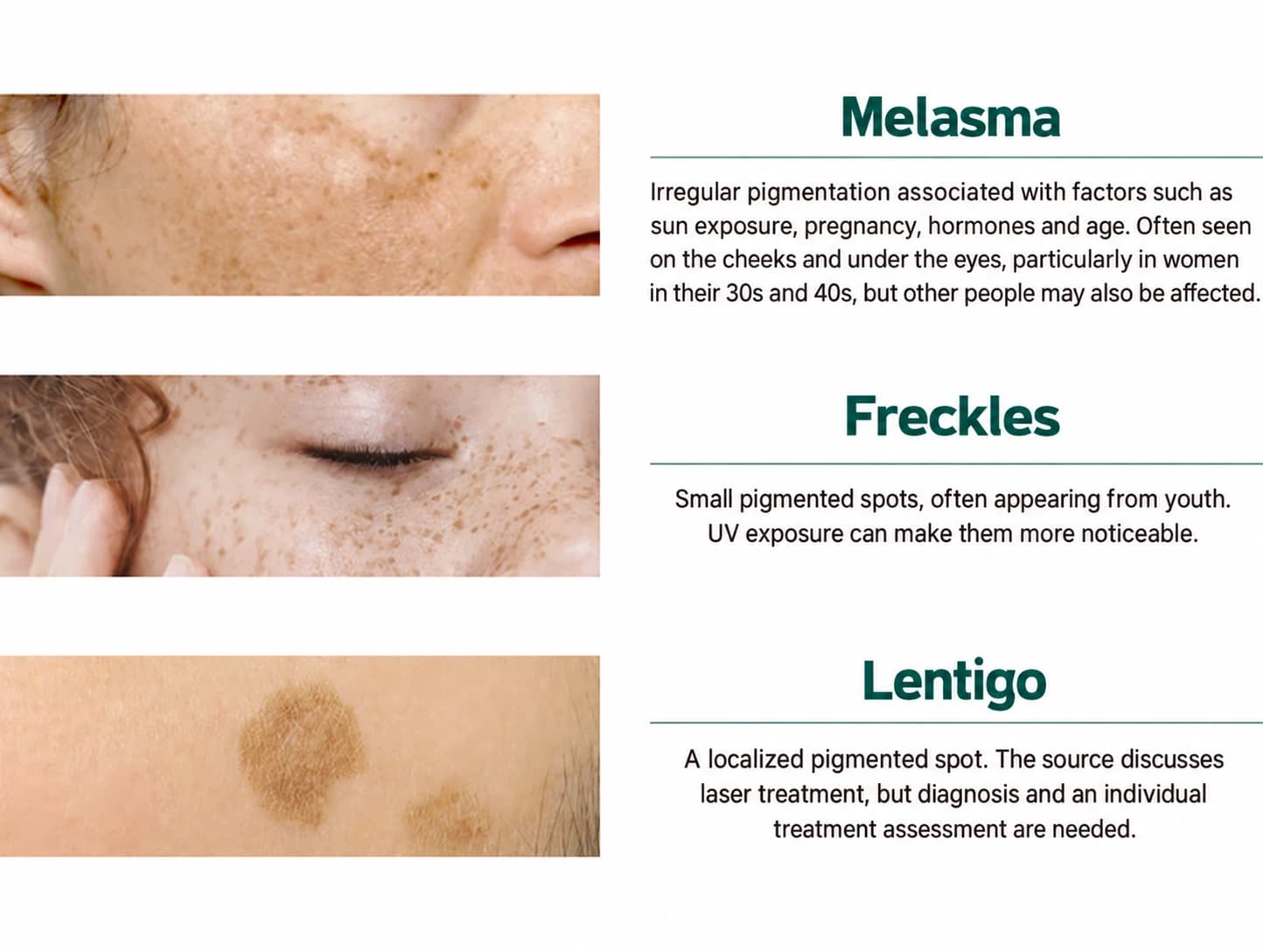 Source illustration of melasma, freckles and lentigines — diagnosis requires clinical assessment — AI-assisted English adaptation; not an unedited medical original