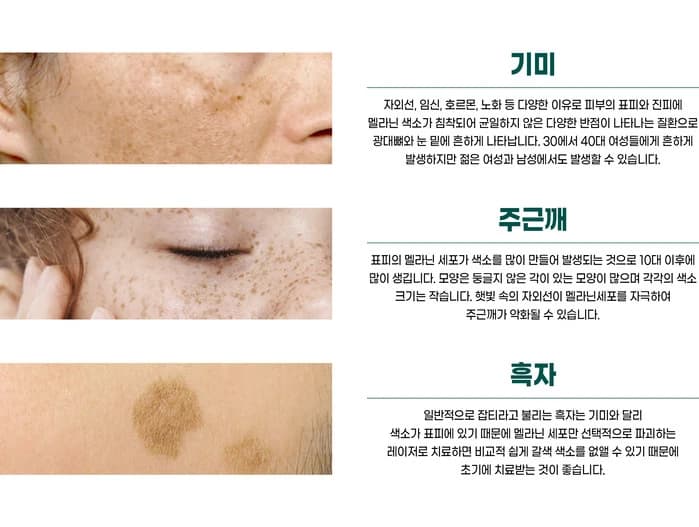 원문 기미·주근깨·흑자 설명 이미지 — 진단은 진료 필요