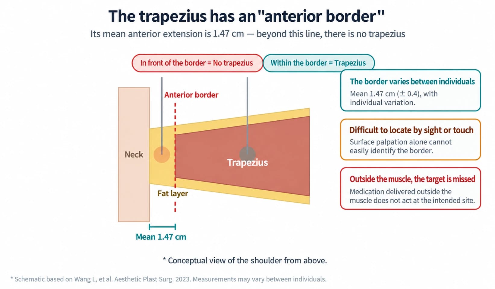 An English diagram showing the anterior border of the trapezius and differences between injection sites