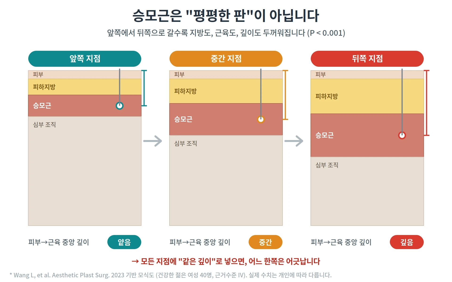 승모근 보톡스의 주입 깊이를 비교하는 원문 도해