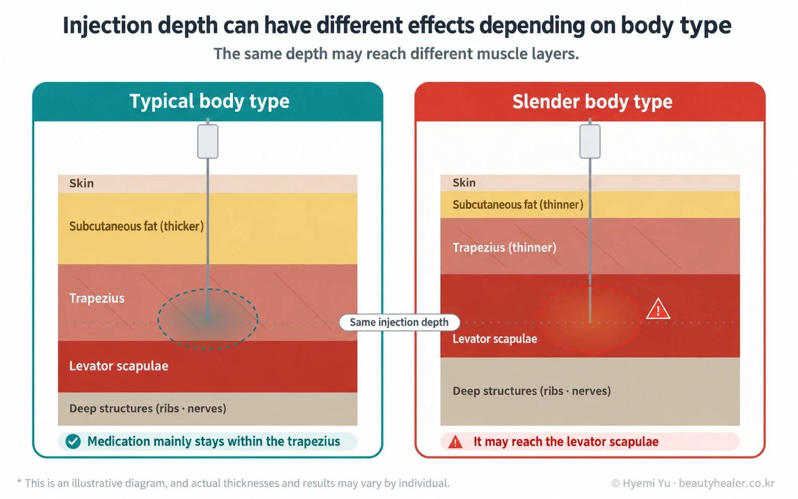 The same injection depth reaching different layers in different body types