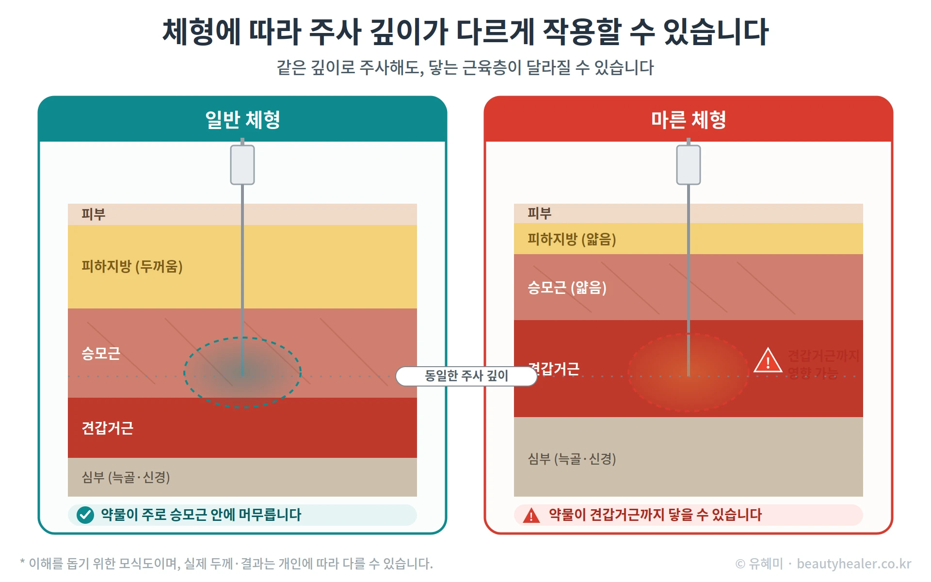 체형에 따른 주사 깊이 차이를 설명하는 도해