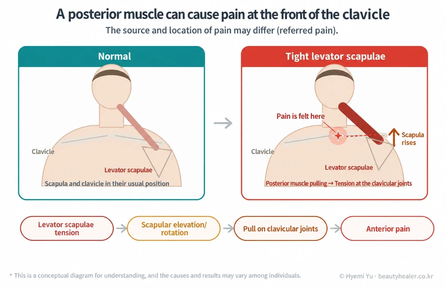Levator scapulae tension, scapular movement, and referred anterior pain
