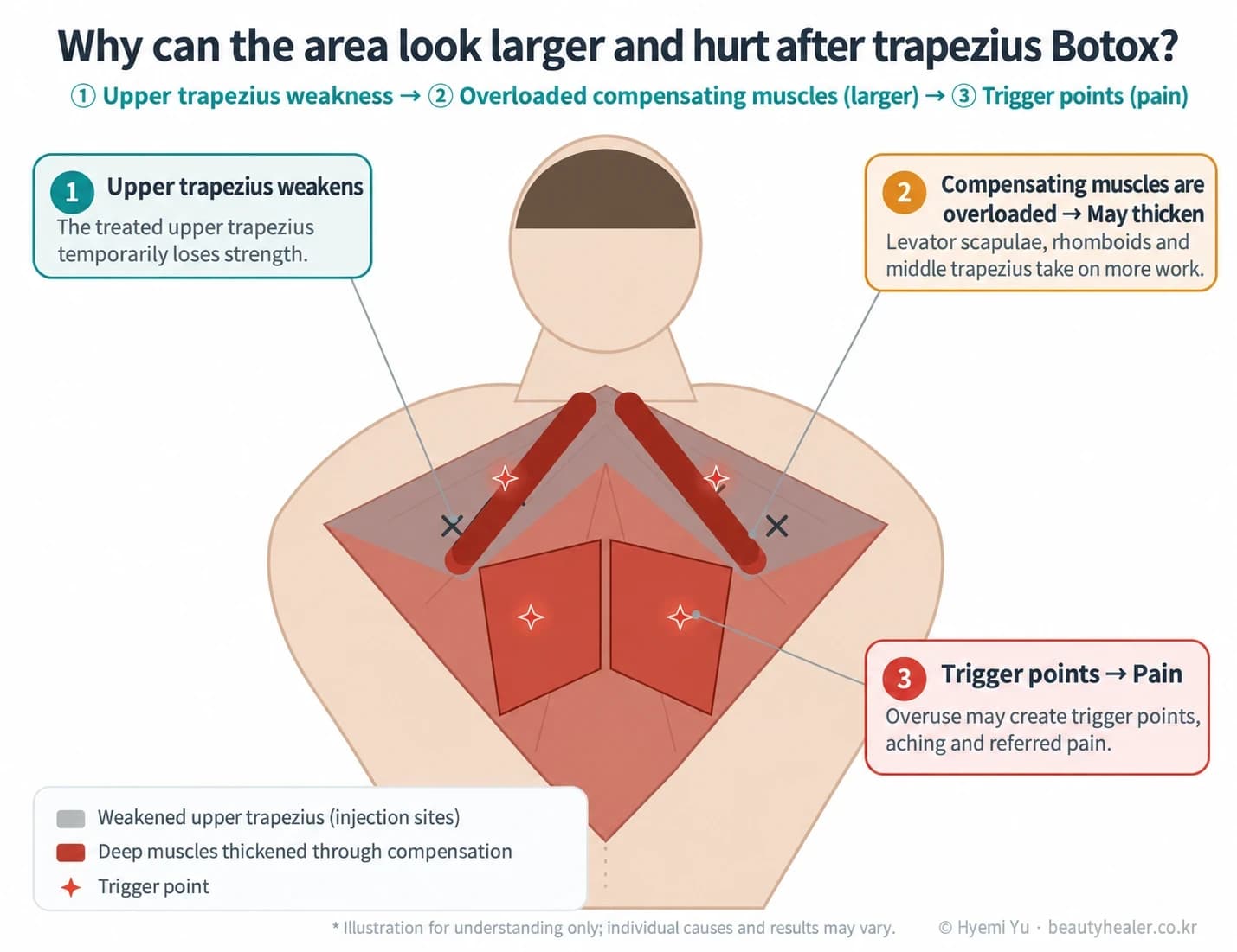 Upper trapezius weakening, compensatory muscle overload, and possible trigger points