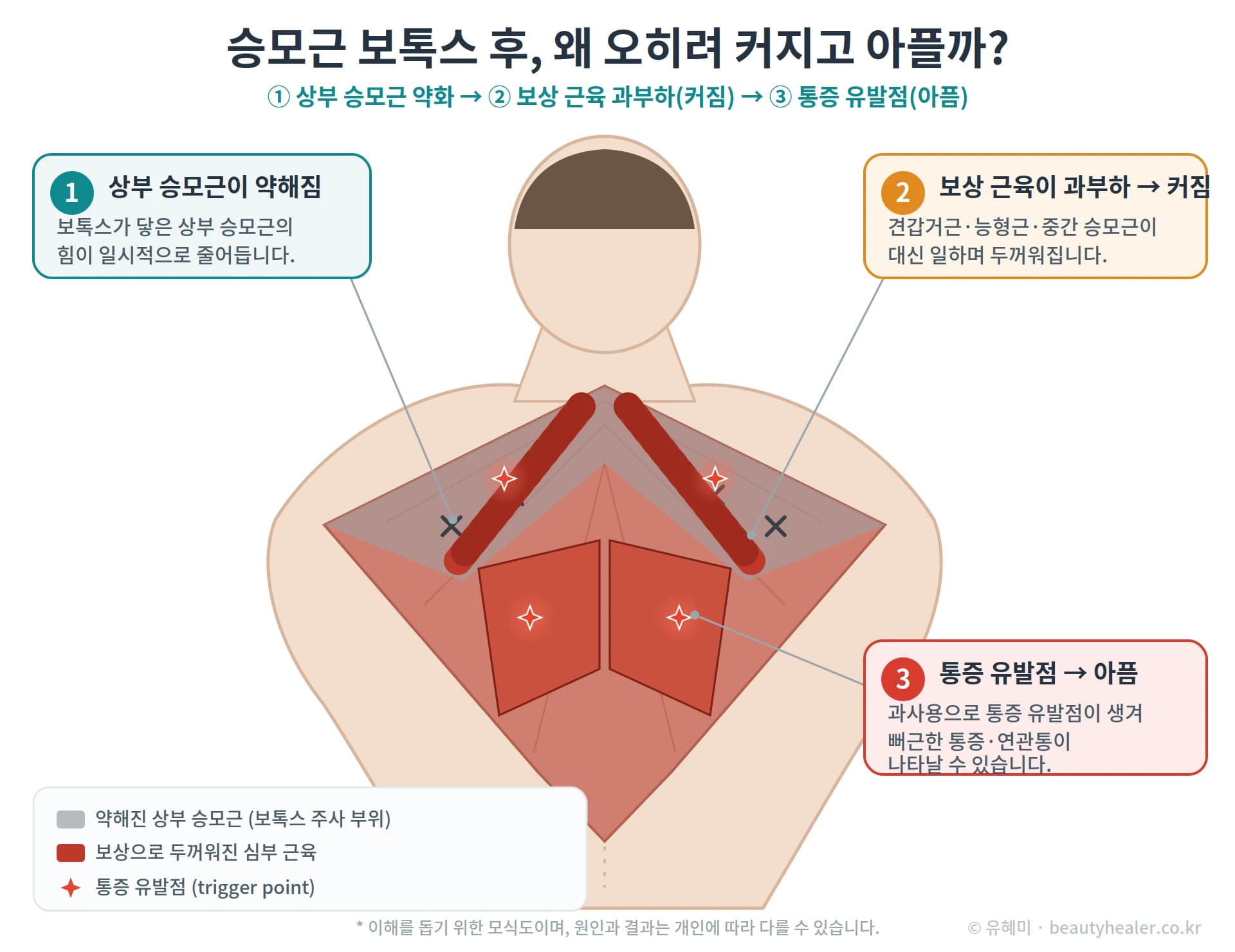 승모근 보톡스 후 통증의 원인을 설명하는 도해