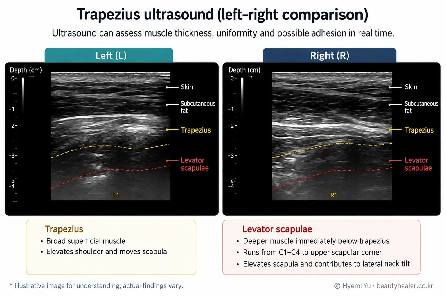 An illustrative left–right ultrasound comparison with English tissue labels