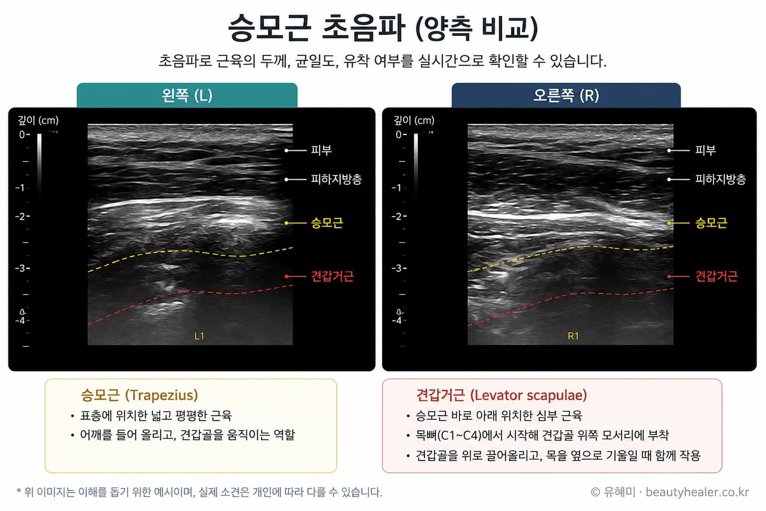 승모근과 견갑거근의 초음파 비교 도해