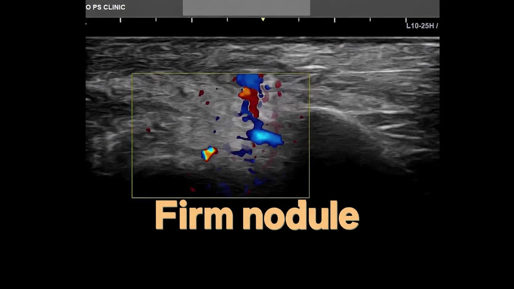 Poster for the source facial-nodule ultrasound video