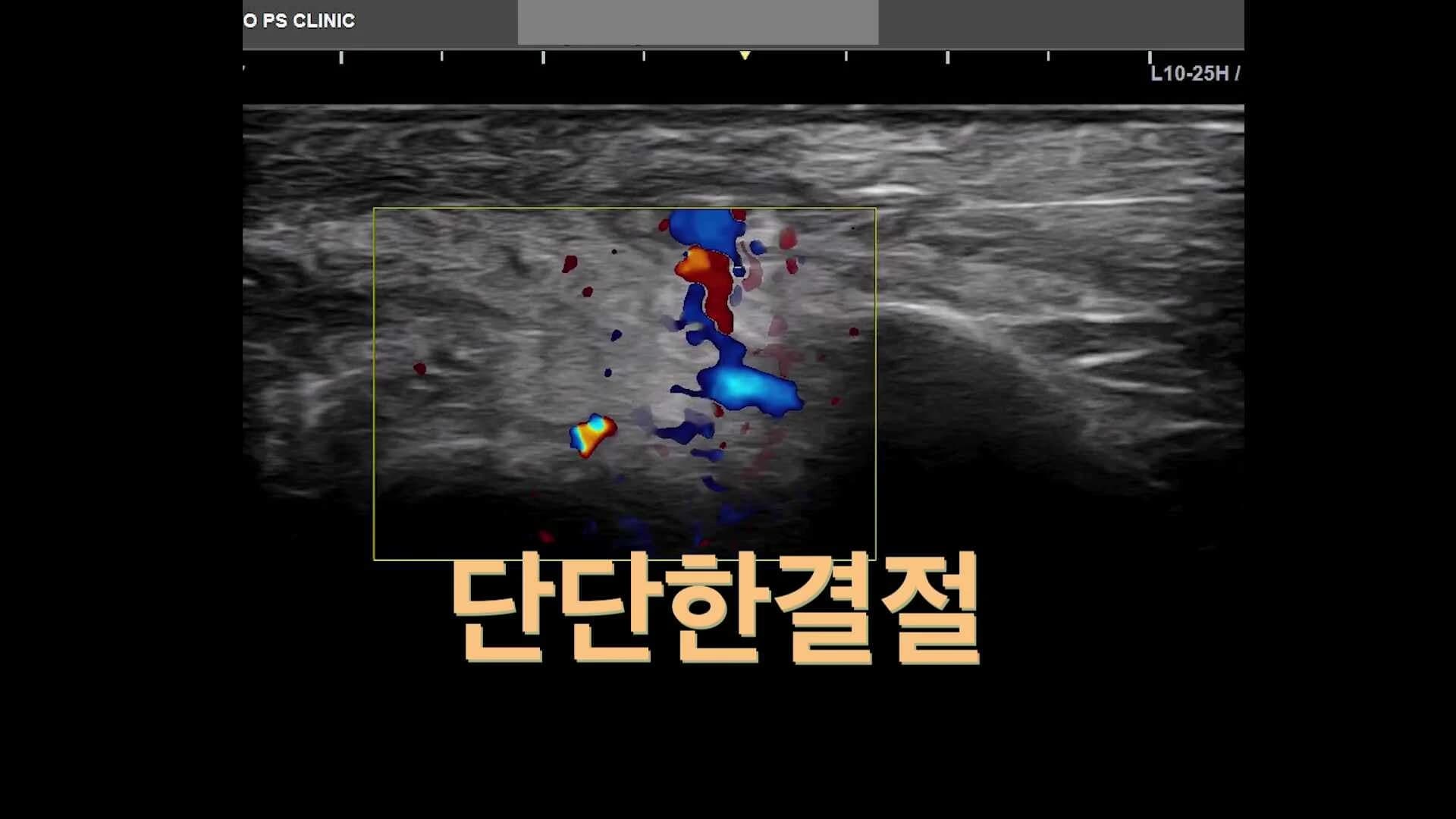 얼굴 결절 초음파 영상의 원문 포스터