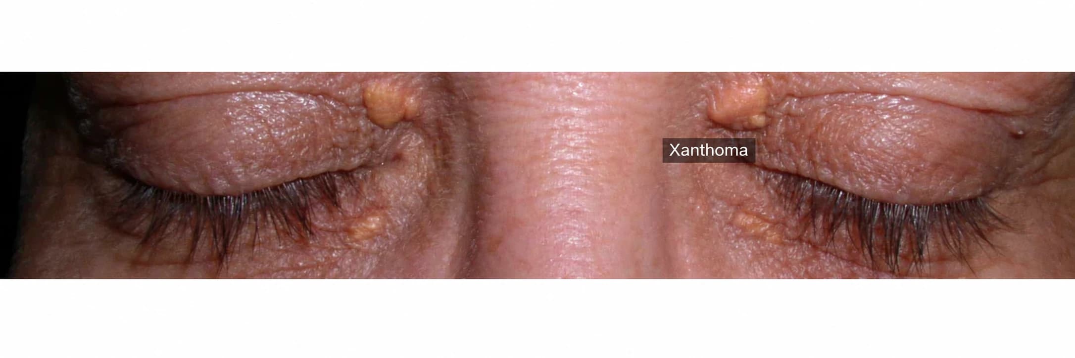 Labeled eyelid lesions in an individual source case — AI-assisted English adaptation; not an unedited medical original