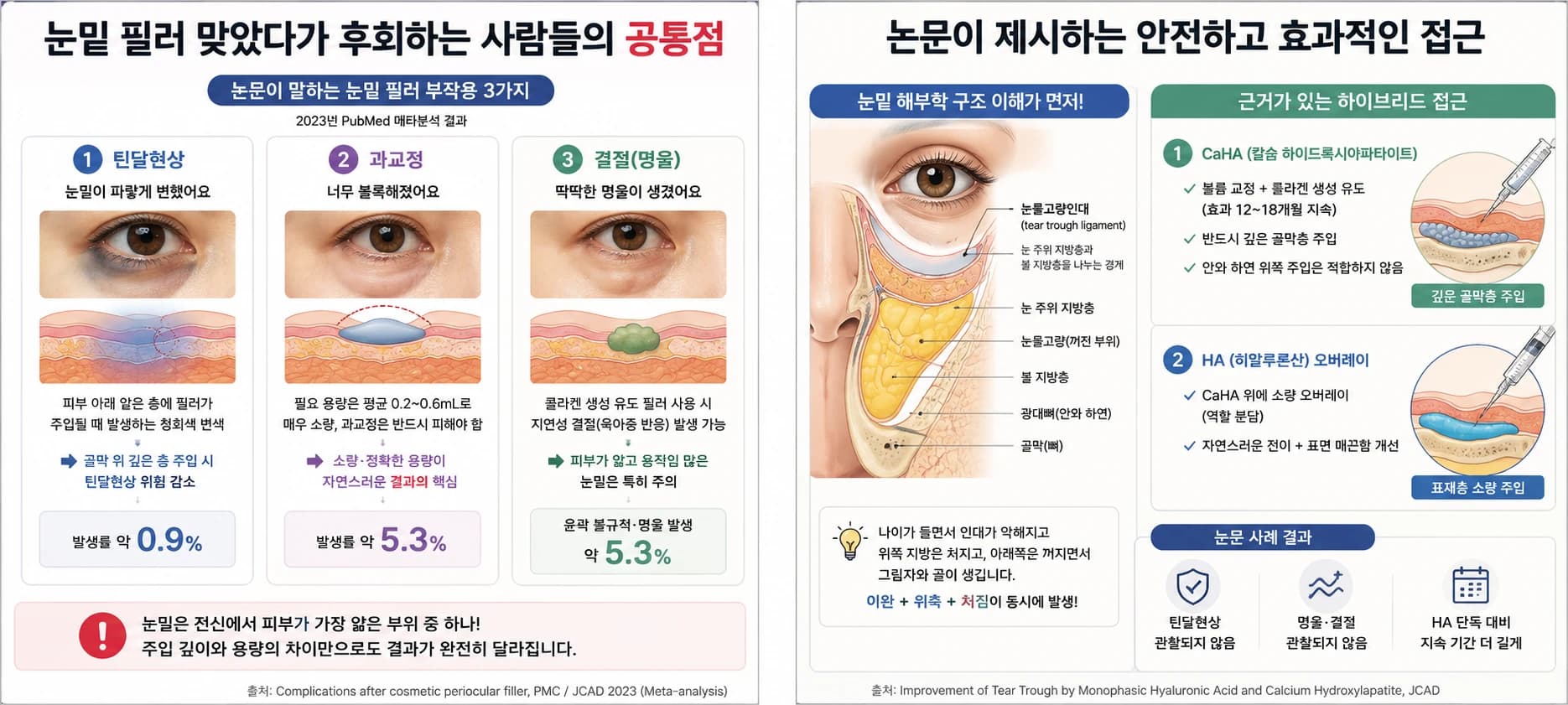 눈밑 필러 상담에서 고려할 점 — 원문 자료 4