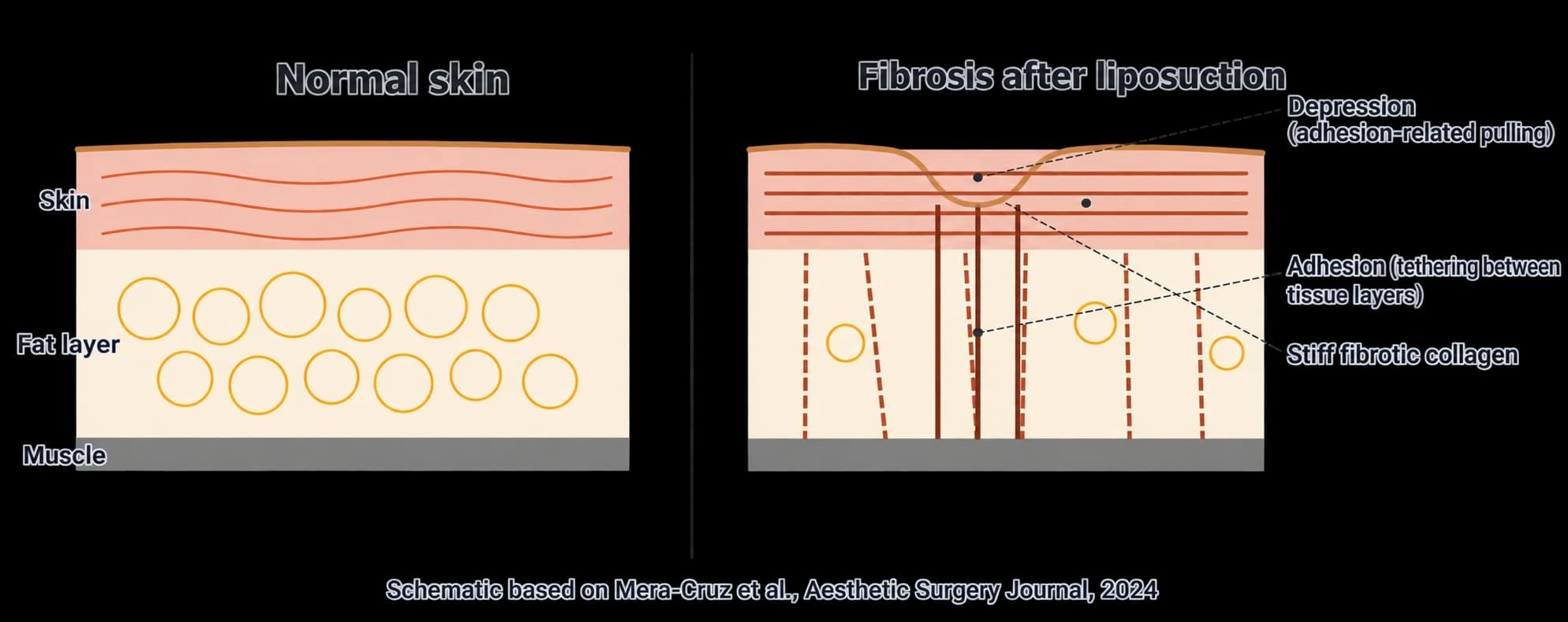 Assessing unevenness after liposuction — source material 2 — AI-assisted English adaptation; not an unedited medical original