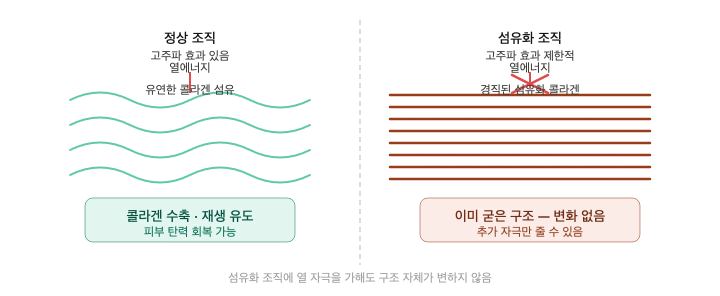 지방흡입 후 울퉁불퉁함을 평가하는 관점 — 원문 자료 4